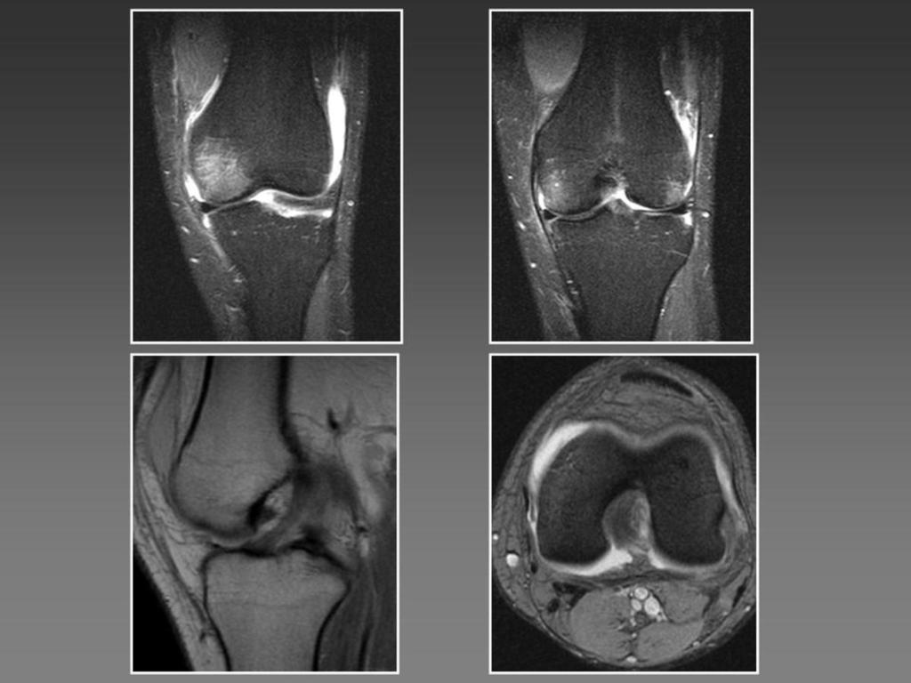 Fig. 10: 25 year-old patient with a history of trauma that presents a partial tear of the ACL of the left knee.