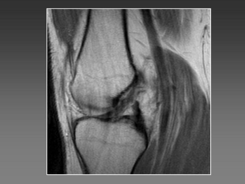 Fig. 11: Chronic partial tear of the ACL.