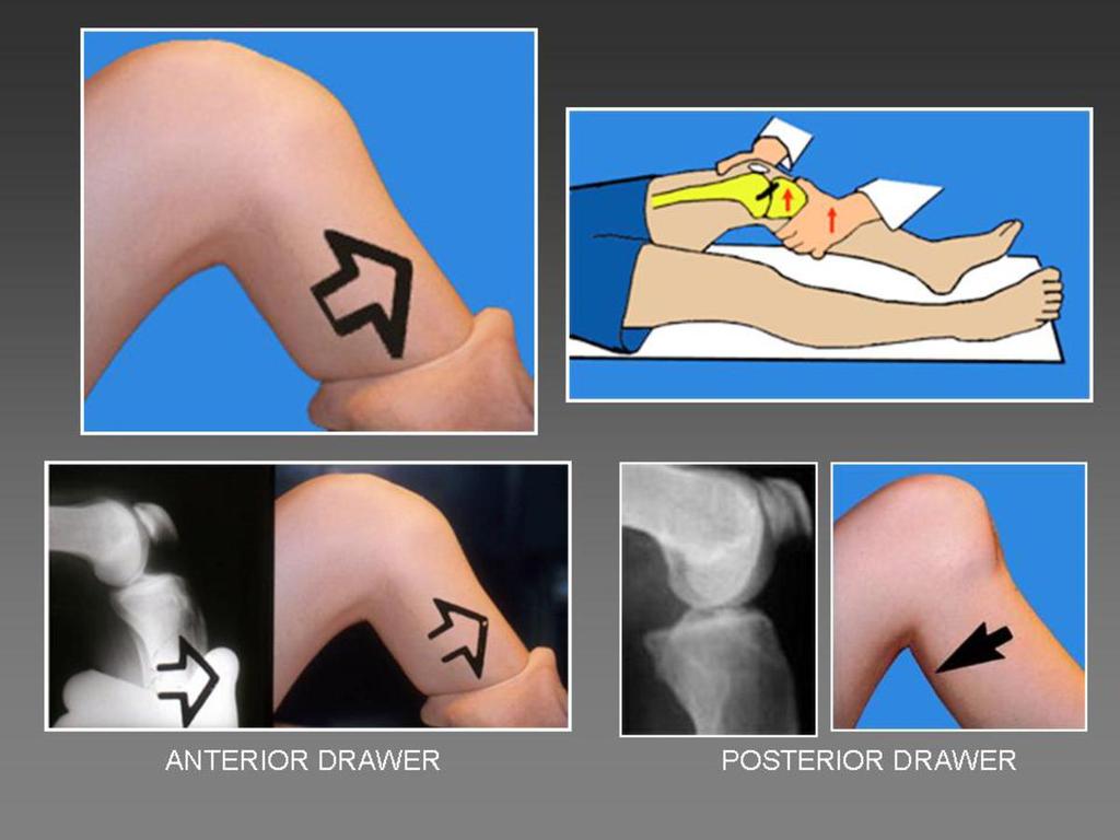 Fig. 3: Physical examination: anterior and posterior drawer tests.