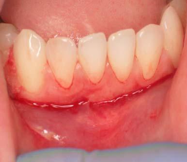 Case 6: Insufficient Zone of Attached Gingiva. Patient presented with insufficient zone of attached gingival tissue.