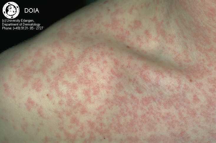 Measles rash Measles rash: Shoulder http://www.dermis.