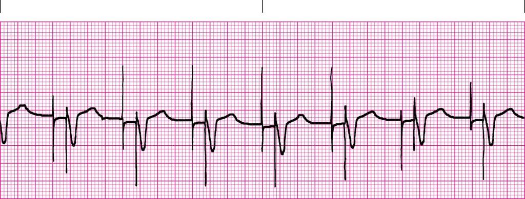 25. Where are pacer spikes? Before the P wave or before the QRS complex?