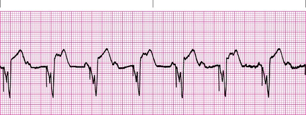 If so, go through the rules of regularity, rate, P waves, PRI, QRS, QT Interpretation? 26. Where are pacer spikes?