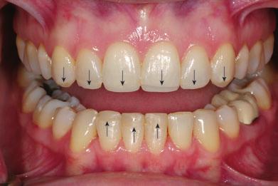 compensatory eruption caused by wear from a vertical chewing pattern, which led to wear of the mandibular incisors that was concealed by the severe vertical overlap.