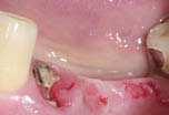 Multiple Teeth After the failure of a root-canal-treated tooth that was part of a