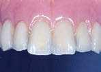 replaced with twelve implants and twelve individual  Implant-Supported Denture