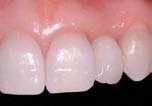 Bicon implants require minimal maintenance and cannot decay, unlike root-canal-treated teeth.