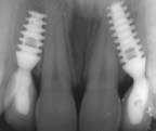 Implant is covered by the gum tissue throughout the healing process. Treatment may be completed in only 3 visits.