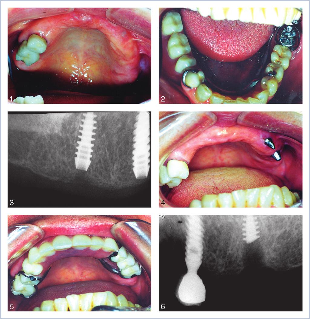 Firas A. M. AL Quran et al FIGURES 1 6. FIGURE 1. The maxillary arch of a 67 year old female with existing restorations were 2 metal-ceramic crowns on the right 2nd bicuspid and 1st molar teeth.