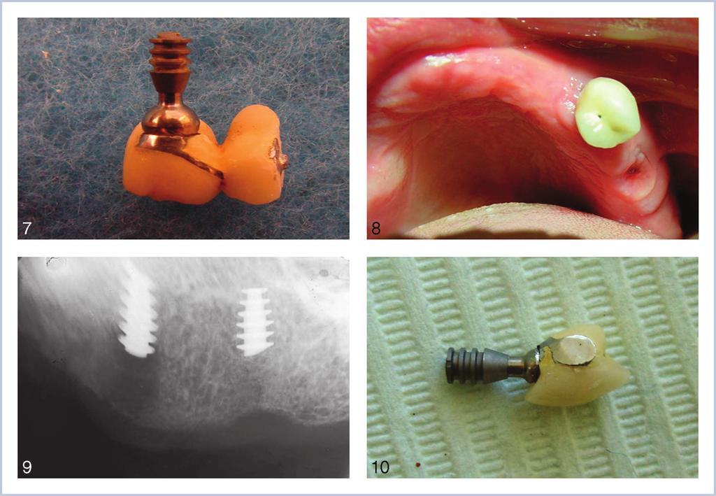 MANAGEMENT OF DENTAL IMPLANT FRACTURES FIGURES 7 10. FIGURE 7. The fixed partial denture was sectioned and the crown on the mesial implant was retained and cemented back in place. FIGURE 8.