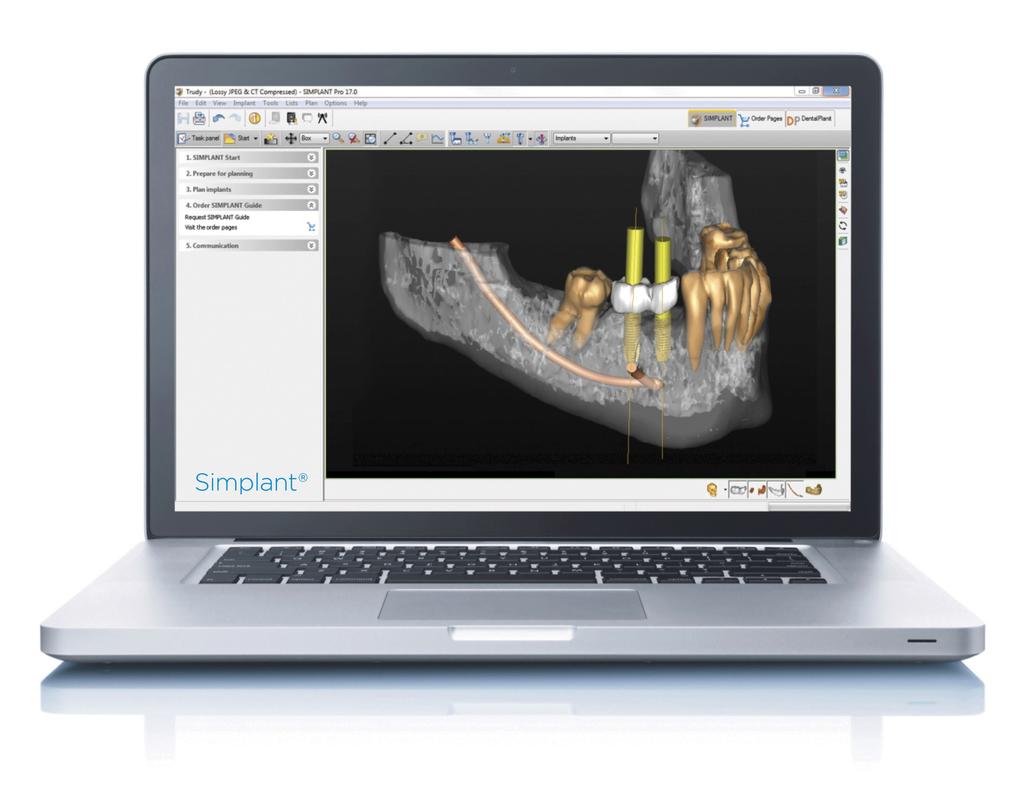 scan, such as bone volume and quality, neighboring teeth, the alveolar nerve, and sinuses Assessment of the soft tissue thickness from the stone model Virtual planning of the implants based on the