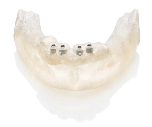 Bone-supported For partially or fully edentulous cases when increased visibility is needed.