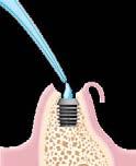 Place an emergence cuff or temporization sleeve onto abutment and modify, if necessary.