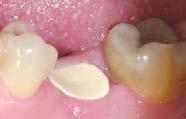 The abutment will support the soft tissue and assist in the formation of the