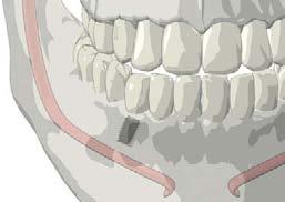 sublingual space in the anterior mandible where the sublingual artery is located.