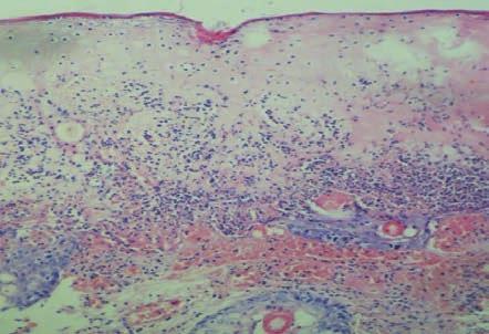 Also the epidermis was necrotic, vesicle formation, easy to desquamate and lesions consisted Picture 8.