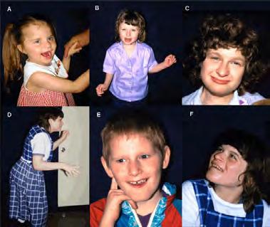 Angelman Syndrome & Prader-Willi Syndrome Sister Syndromes Angelman Syndrome ~1/20,000 births happy disposition smile often bouts of laughter minimal verbal skills