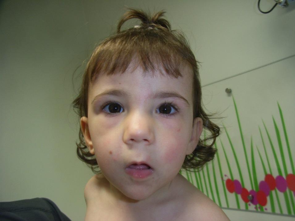 KT 6 year old girl with global developmental delay Walked at 2 years Non-verbal Loves water, sensory stimulation Calcaneovalgus deformity Bilateral esotropia 2 x UTIs