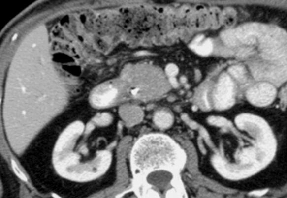 AIP: Imaging Features in Pancreas
