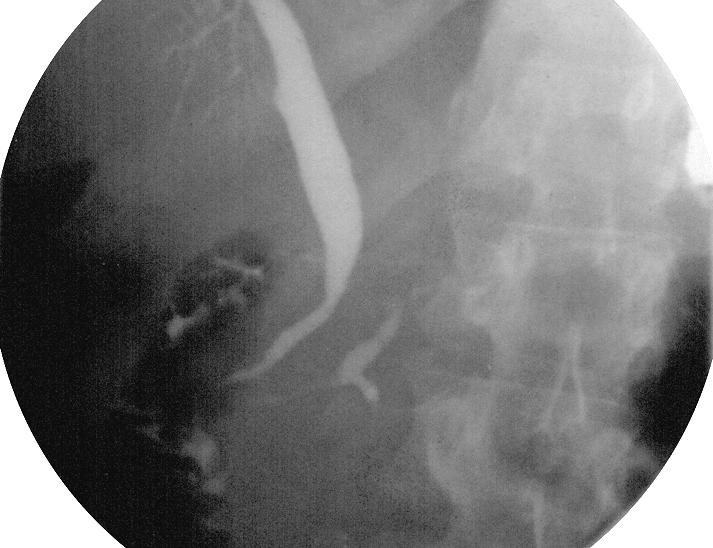 Stricture of intrahepatic