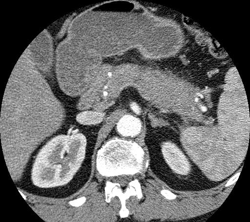 Diffuse CT Features Pancreas-Typical Diffuse enlargement