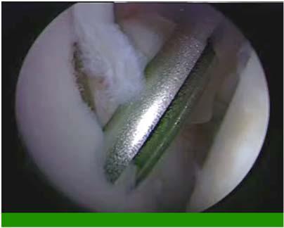 labral and capsular tissue Both