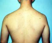 Differential Diagnosis Brachial plexus syndrome (burner) Shoulder subluxation