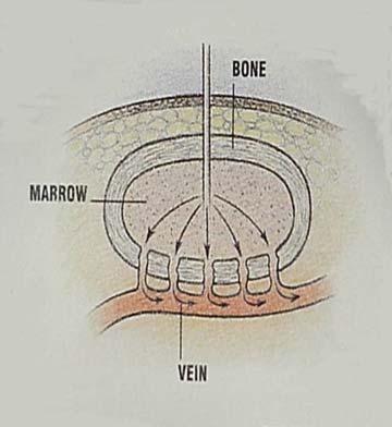 Vascular Access Via IO Infuses fluids into bone marrow Bone marrow drains into