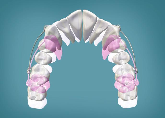 with direct bonded tubes on lower molars, a passive lingual arch, a full mandibular fixed appliance, or mini-screws).