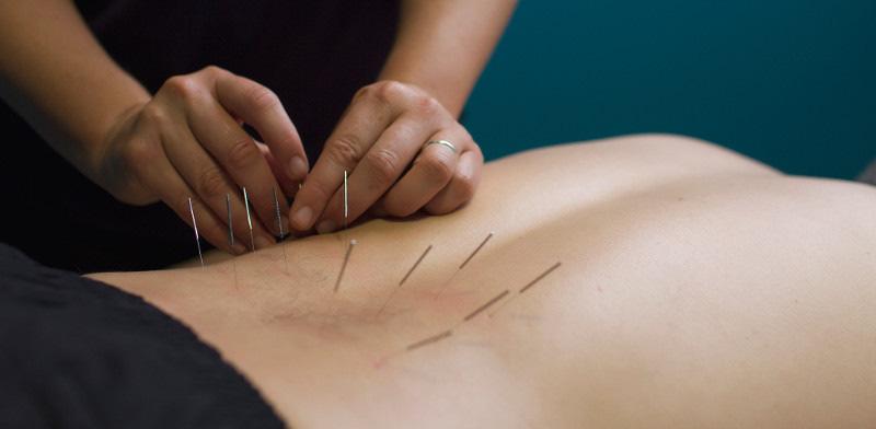 Dry needling Thin needles inserted into the muscle to stimulate the trigger point and elicit a local twitch response Trigger point is tight muscle band that triggers pain when touched It is different