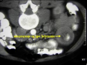 lesion, without differences in density. Image 5.
