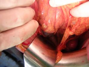Metastasis in the pancreas on the upper edge of the body,