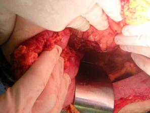 Resection margins of the pancreas. Image 10.