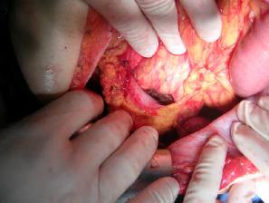 Gastric and duodenal stump after