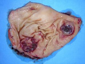 Image 20. Metastases of the stomach.