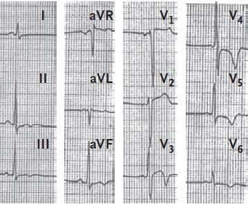 229 athletes with normal ECGs After 12 +/- 5 years: 6% developed cardiomyopathy: 1 SCD from ARVC, 3 HCM, 1