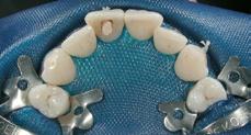 perfect isolation of the tooth setting an effective barrier between the oral cavity and the area of treatment.