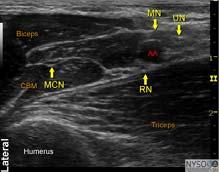 nerve musculocutaneous (found in fascial layers between biceps and