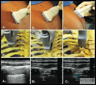 Clinical pearls Transvers advancement of the needle should be reserved only for patients who image well; visualization of the needle path at all times is crucial to reduce the risk of needle entry in