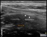 Needle Approach and injection The success of the block is best predicted by documenting the spread of the local anesthetic toward the femoral nerve medially and underneath the sartorius muscle