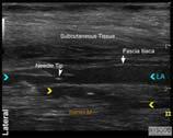 branch of the obturator nerve is unreliable with fascia iliaca block Clinical pearls Often there are several hyper echoic lines superficial to the iliopsoas muscle on the ultrasound image Use a nerve