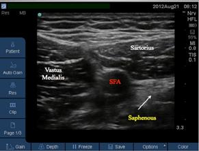 Ultrasound scanning Begins with probe on anterior thigh to identify femur and overlying vastus medialis muscle Scan more medially until the vastus medialis terminates and the sartorius muscle is seen