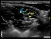 Ultrasound scanning Begin at the midpoint of the clavicle Find the subclavian artery (SA) Hold the probe so the SA is seen in axial cross section and is circular Brachial plexus noted as hypoechoic