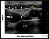 Ultrasound guided supraclavicular brachial plexus nerve block Supraclavicular anatomy Subclavian artery (SA) passes over first rib between