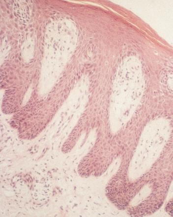 1 Epidemiology and histology The incidence of psoriasis has been estimated by census studies and postal questionnaires, and the reliability of some of the studies is open to question.
