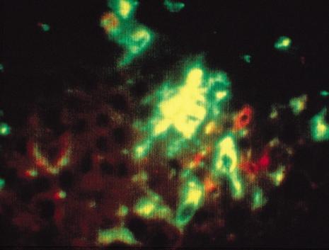 AN ATLAS OF PSORIASIS Figure 7 CD8 lymphocytes (red) in close apposition to the dendritic processes (green) of antigen-presenting cells in the resolution of guttate psoriasis disease, the CD8 cells
