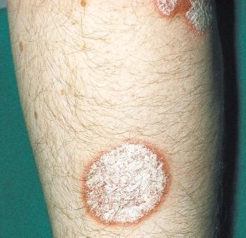 6 Clinical features AGE OF ONSET Psoriasis may begin at any age, but it is rare under the age of 10 years. It is most likely to appear first between the ages of 15 and 30 years.