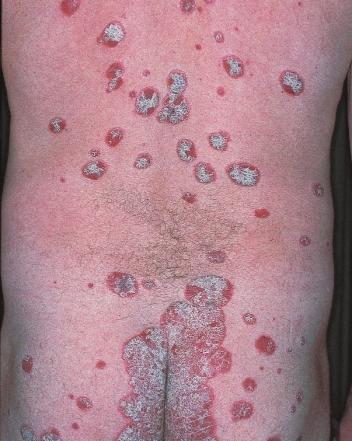 CLINICAL FEATURES Figure 21 psoriasis Thick gray