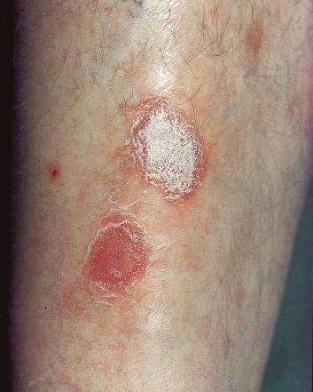 Excoriation of a plaque converting a red,