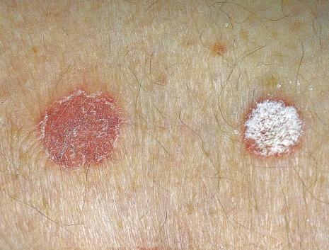 23 Two similar red plaques of psoriasis.